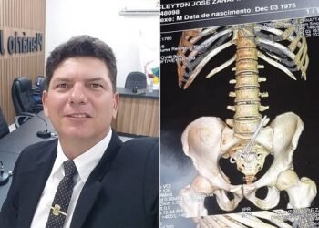 Médicos esquecem tesoura dentro do corpo de vereador após cirurgia